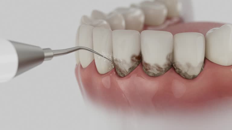 Reliable Wisdom Tooth Removal contractor in Glen Ellen, CA by Smile Center Dentistry
